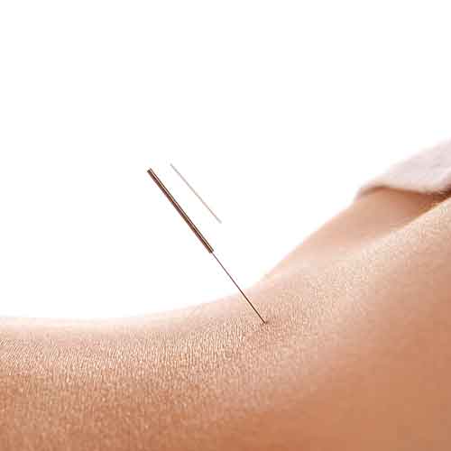 acupuncture image